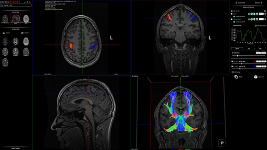nordicBrainEx